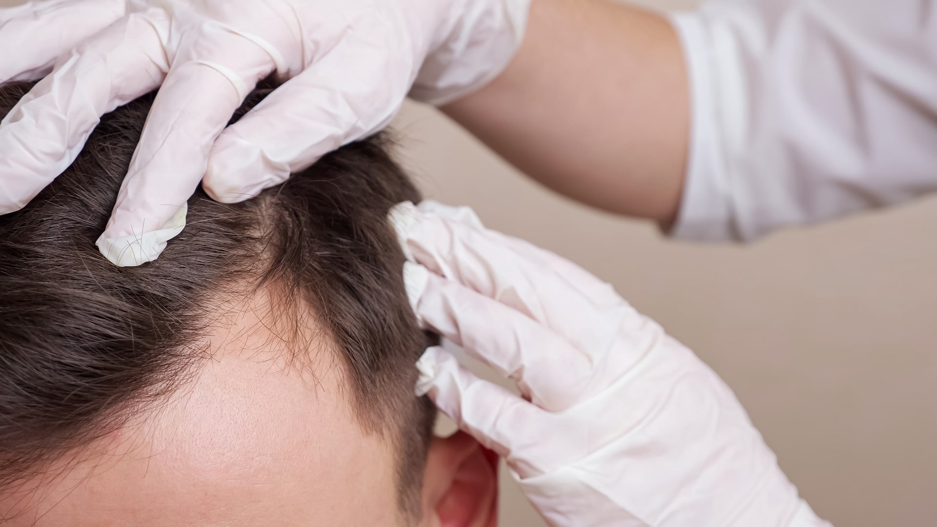 Hair Transplant Treatment