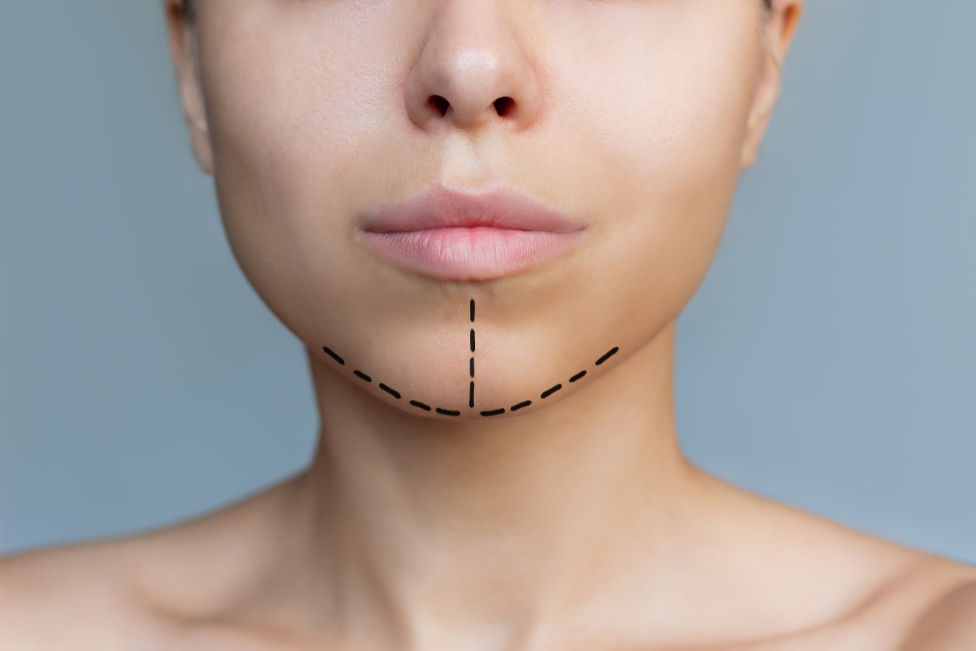 Chin Treatment (Mentoplasty)